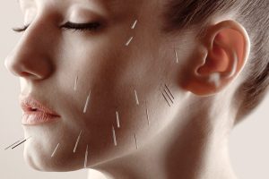 Rejuvenecimiento facial con acupuntura
